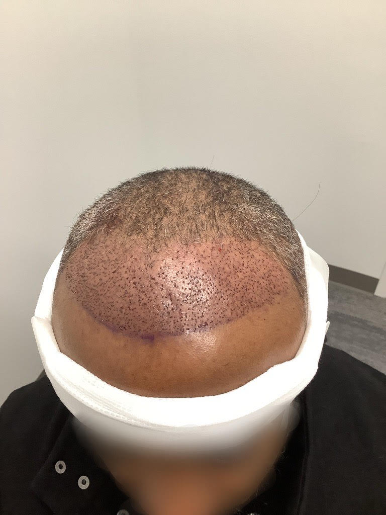 directly after a FUE hair transplant