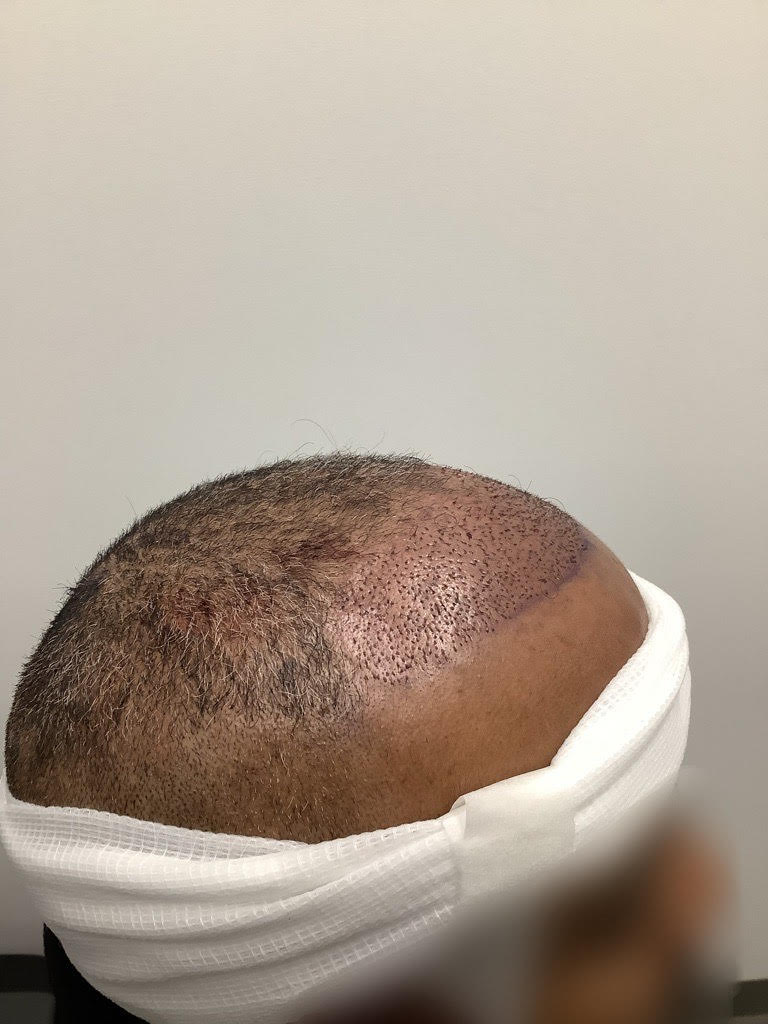 directly after a FUE hair transplant
