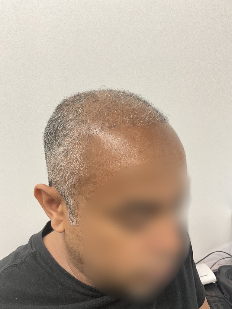 After FUE Hair Transplant, 6 months