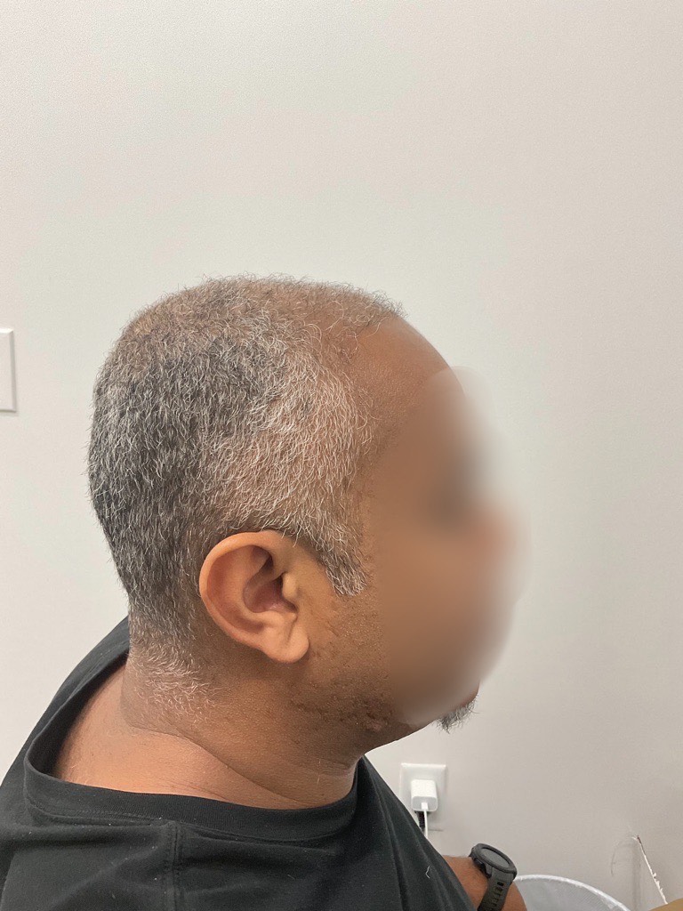 After FUE Hair Transplant, 6 months