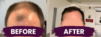 before and after fue transplant