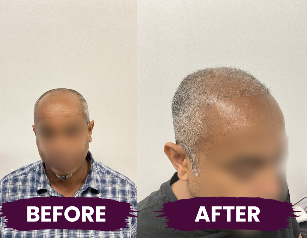 before and after a FUE hair transplant